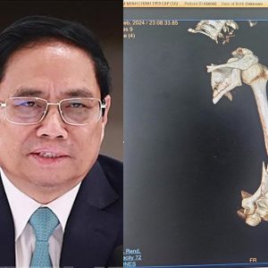 Thủ tướng Phạm Minh Chính gãy tay do tai nạn giao thông hay ám sát?
